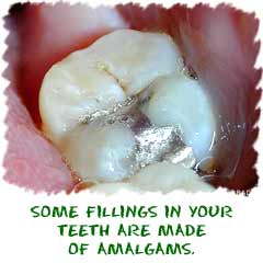 Amalgams in your teeth